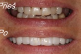 Dantų implantai - implantacija, protezavimas