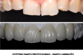 Estetinis dantų protezavimas - laminatės