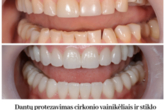 Estetinis dantų protezavimas - laminatės