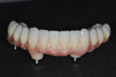 Dantų implantai - implantacija, protezavimas